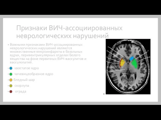 Признаки ВИЧ-ассоциированных неврологических нарушений Важными признаками ВИЧ-ассоциированных неврологических нарушений являются