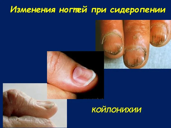 Изменения ногтей при сидеропении КОЙЛОНИХИИ