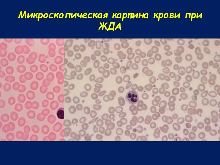 Микроскопическая картина крови при ЖДА