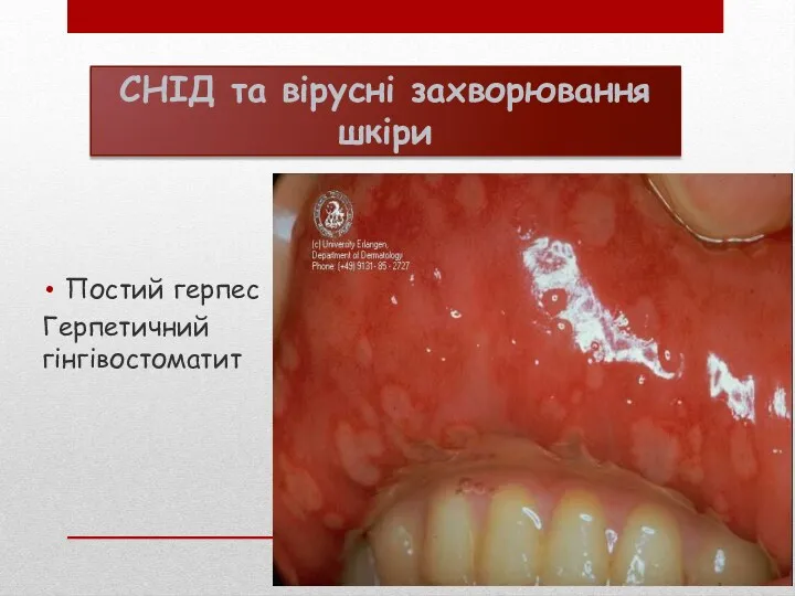 СНІД та вірусні захворювання шкіри Постий герпес Герпетичний гінгівостоматит