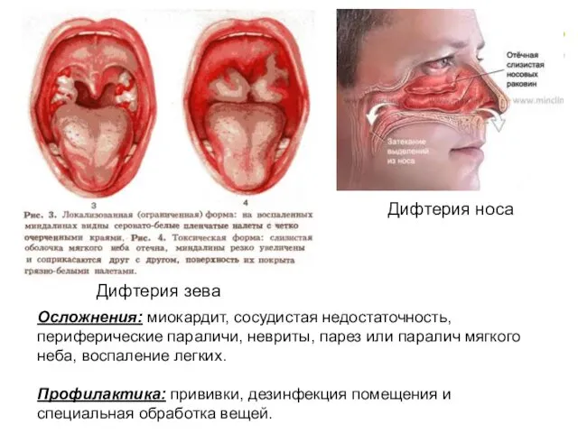 Дифтерия зева Дифтерия носа Осложнения: миокардит, сосудистая недостаточность, периферические параличи,