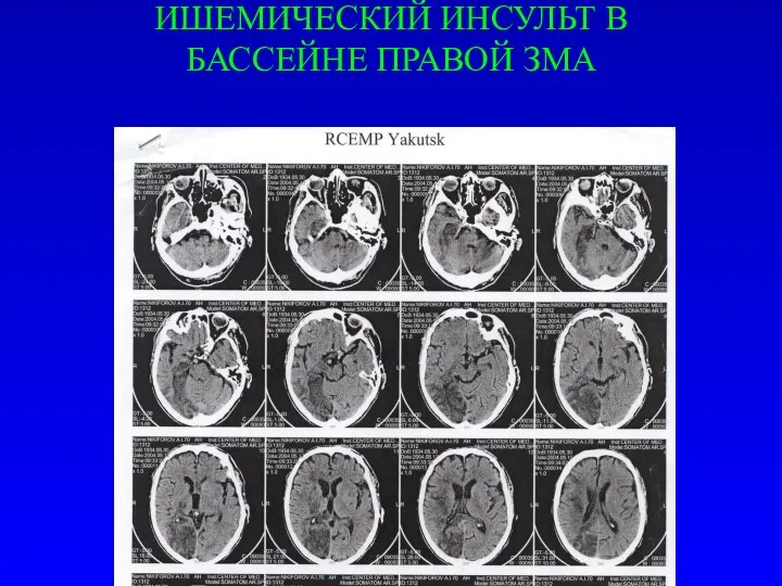 ИШЕМИЧЕСКИЙ ИНСУЛЬТ В БАССЕЙНЕ ПРАВОЙ ЗМА