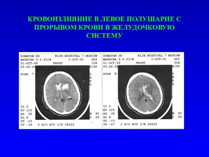 КРОВОИЗЛИЯНИЕ В ЛЕВОЕ ПОЛУШАРИЕ С ПРОРЫВОМ КРОВИ В ЖЕЛУДОЧКОВУЮ СИСТЕМУ