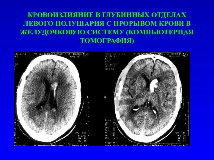 КРОВОИЗЛИЯНИЕ В ГЛУБИННЫХ ОТДЕЛАХ ЛЕВОГО ПОЛУШАРИЯ С ПРОРЫВОМ КРОВИ В ЖЕЛУДОЧКОВУЮ СИСТЕМУ (КОМПЬЮТЕРНАЯ ТОМОГРАФИЯ)