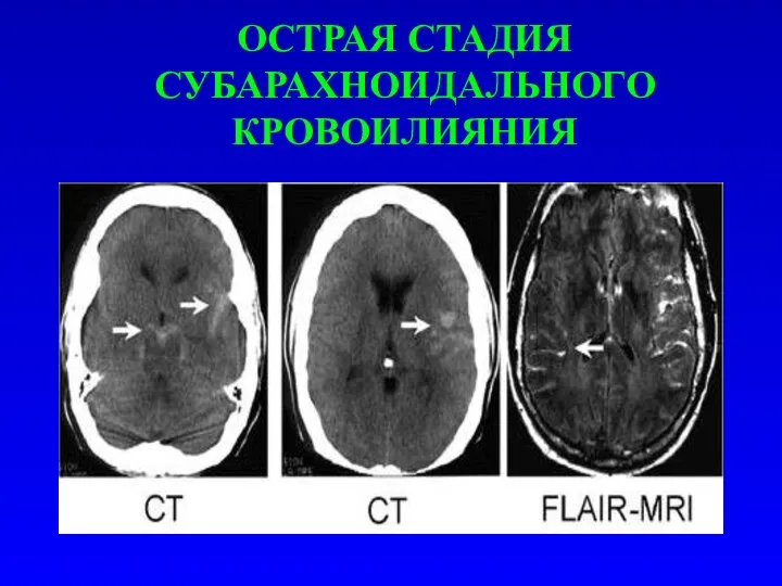 ОСТРАЯ СТАДИЯ СУБАРАХНОИДАЛЬНОГО КРОВОИЛИЯНИЯ