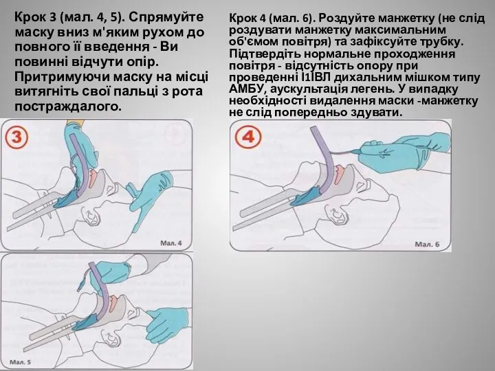 Крок 3 (мал. 4, 5). Спрямуйте маску вниз м'яким рухом