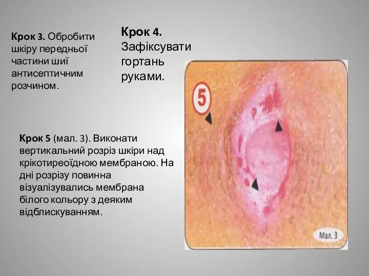 Крок 3. Обробити шкіру передньої частини шиї антисептичним розчином. Крок