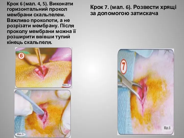 Крок 6 (мал. 4, 5). Виконати горизонтальний прокол мембрани скальпелем.