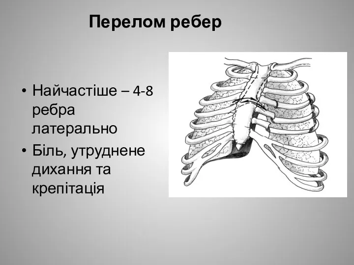 Перелом ребер Найчастіше – 4-8 ребра латерально Біль, утруднене дихання та крепітація