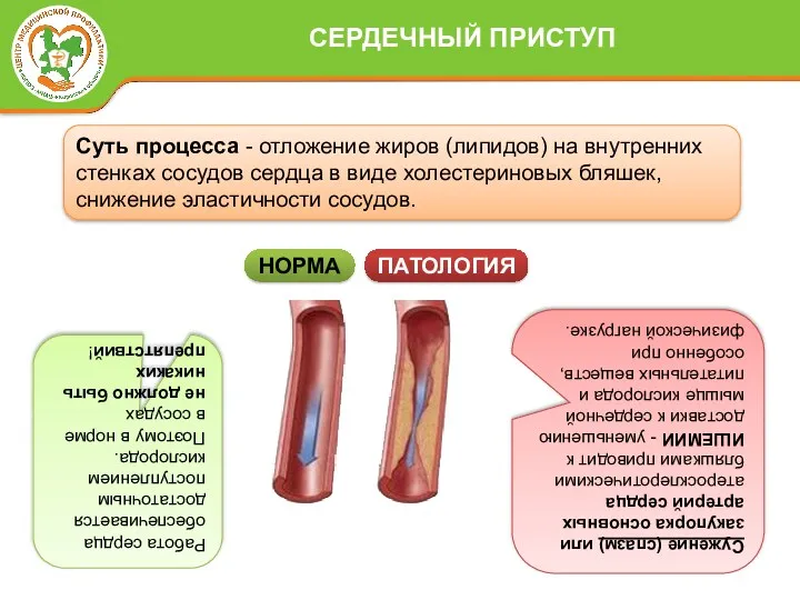 Суть процесса - отложение жиров (липидов) на внутренних стенках сосудов