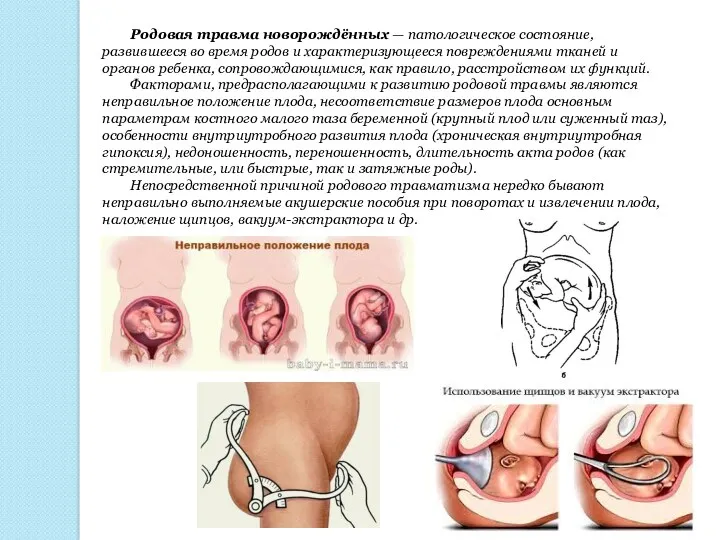 Родовая травма новорождённых — патологическое состояние, развившееся во время родов