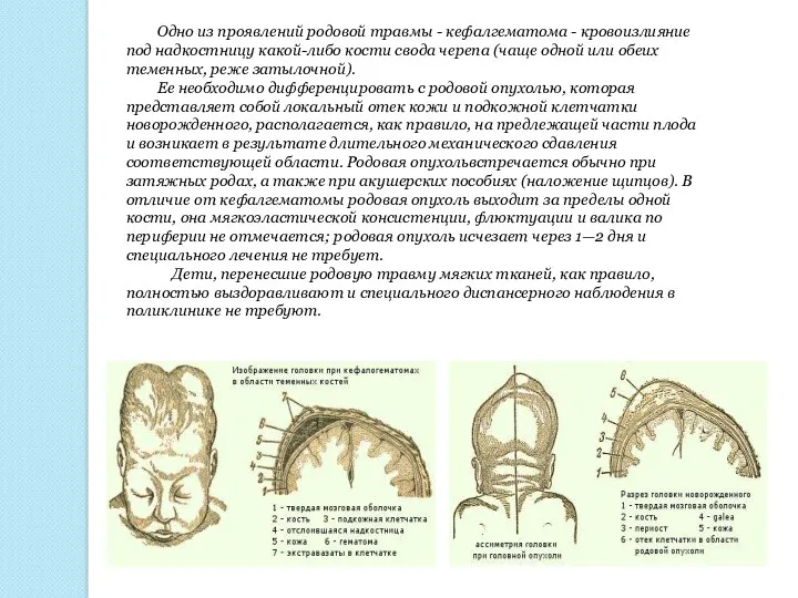 Одно из проявлений родовой травмы - кефалгематома - кровоизлияние под