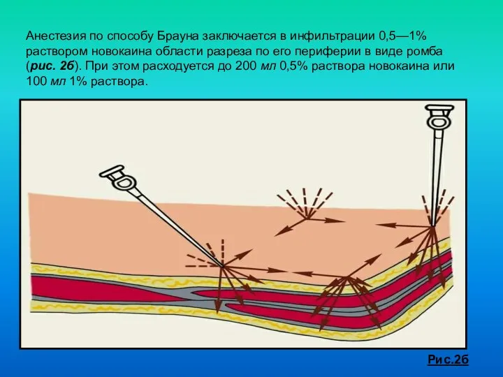 Анестезия по способу Брауна заключается в инфильтрации 0,5—1% раствором новокаина