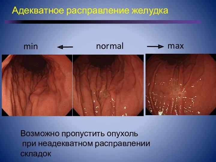 normal min max Возможно пропустить опухоль при неадекватном расправлении складок Адекватное расправление желудка