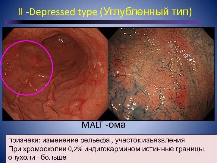 II -Depressed type (Углубленный тип) MALT -ома признаки: изменение рельефа , участок изъязвления