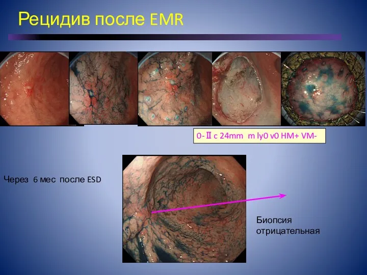 Рецидив после EMR 0-Ⅱc 24mm m ly0 v0 HM+ VM- Биопсия отрицательная Через