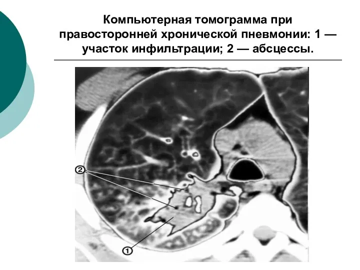 Компьютерная томограмма при правосторонней хронической пневмонии: 1 — участок инфильтрации; 2 — абсцессы.