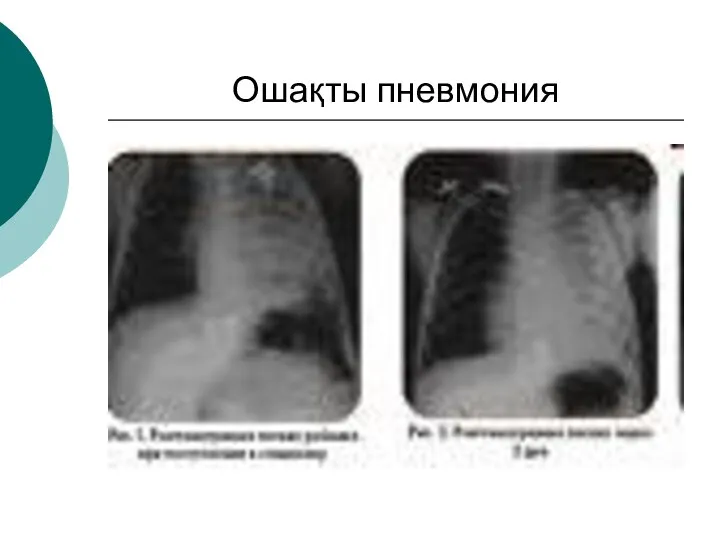 Ошақты пневмония