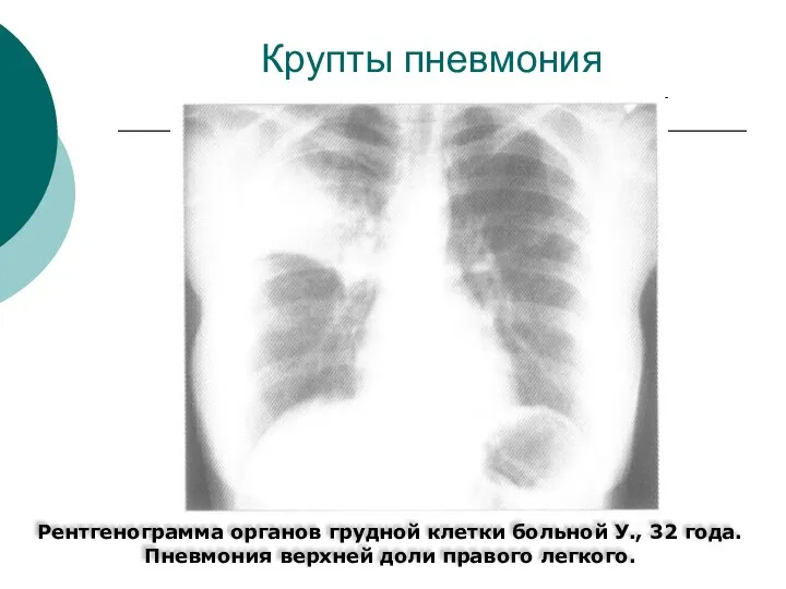 Крупты пневмония Рентгенограмма органов грудной клетки больной У., 32 года. Пневмония верхней доли правого легкого.