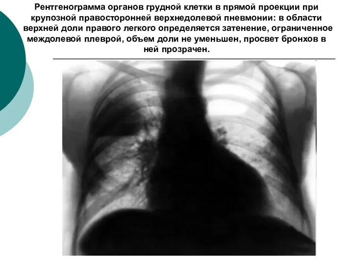 Рентгенограмма органов грудной клетки в прямой проекции при крупозной правосторонней