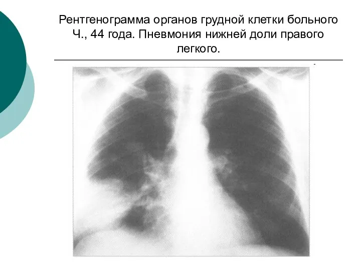 Рентгенограмма органов грудной клетки больного Ч., 44 года. Пневмония нижней доли правого легкого.