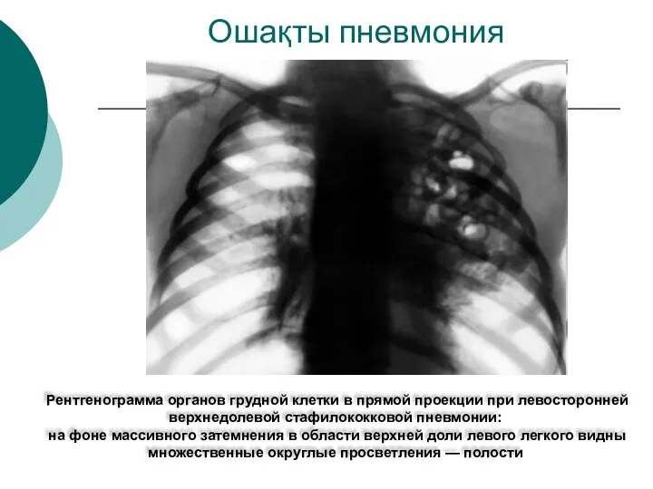 Ошақты пневмония Рентгенограмма органов грудной клетки в прямой проекции при