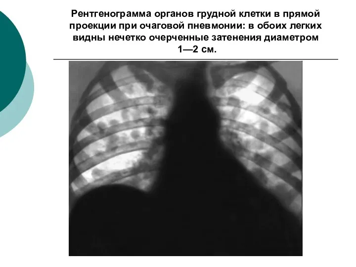 Рентгенограмма органов грудной клетки в прямой проекции при очаговой пневмонии: