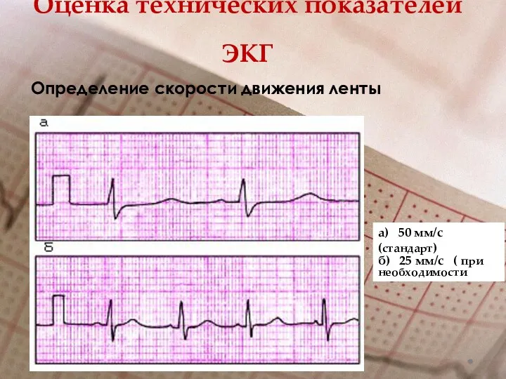 Оценка технических показателей ЭКГ Определение скорости движения ленты а) 50 мм/с (стандарт) б)