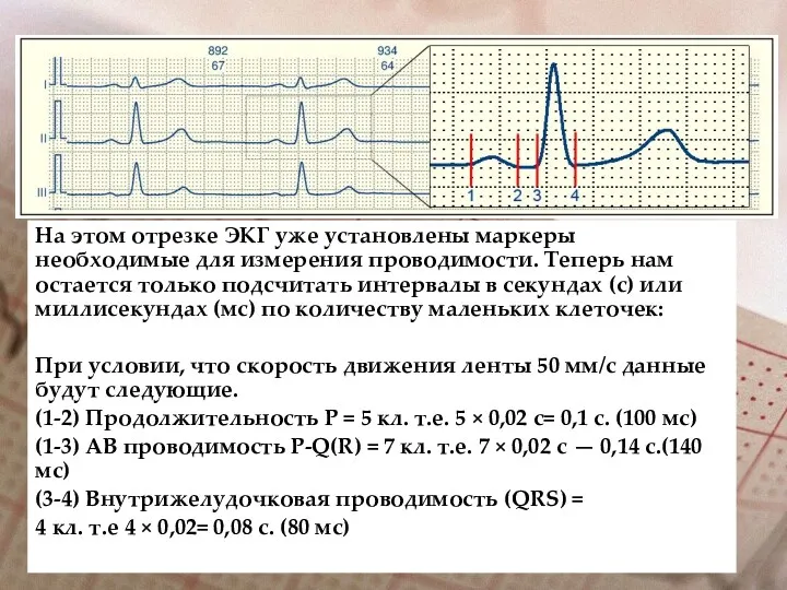 На этом отрезке ЭКГ уже установлены маркеры необходимые для измерения проводимости. Теперь нам