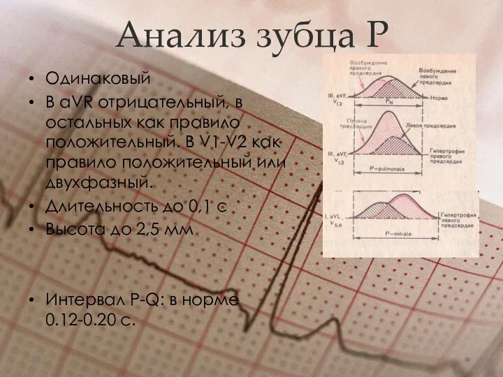 Анализ зубца Р Одинаковый В aVR отрицательный, в остальных как