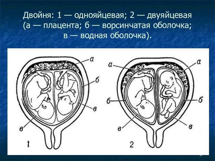 Двойня: 1 — однояйцевая; 2 — двуяйцевая (а — плацента;