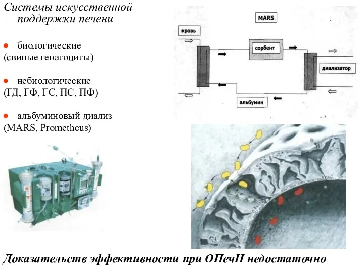 Системы искусственной поддержки печени биологические (свиные гепатоциты) небиологические (ГД, ГФ,