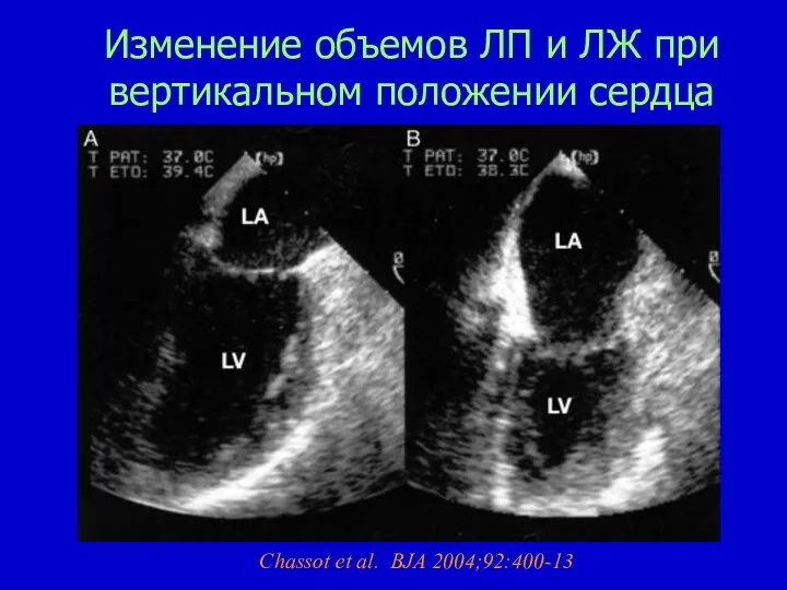 Изменение объемов ЛП и ЛЖ при вертикальном положении сердца Chassot et al. BJA 2004;92:400-13