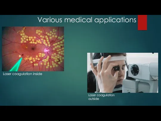 Various medical applications Laser coagulation inside Laser coagulation outside