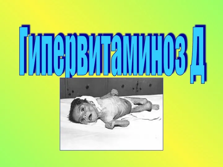 Гипервитаминоз Д