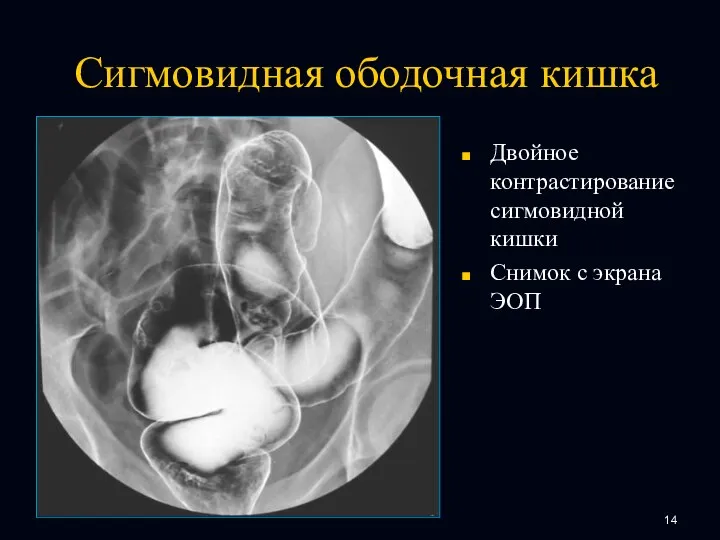 Сигмовидная ободочная кишка Двойное контрастирование сигмовидной кишки Снимок с экрана ЭОП