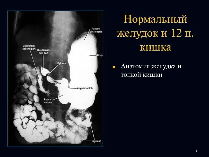 Нормальный желудок и 12 п. кишка Анатомия желудка и тонкой кишки