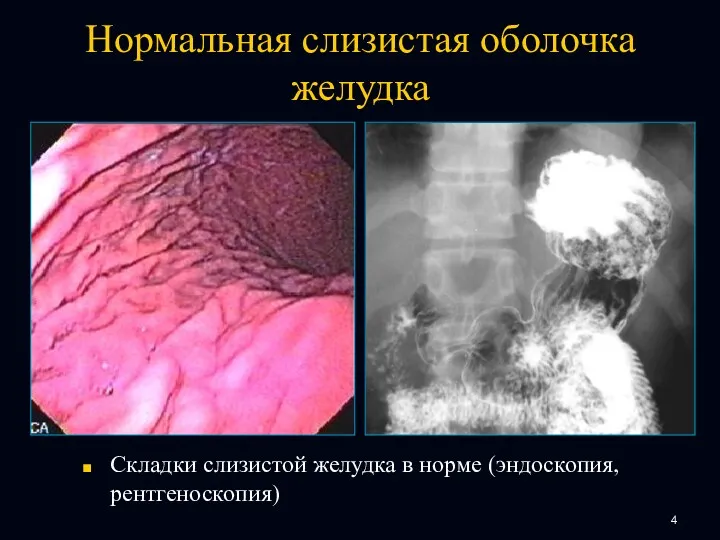 Нормальная слизистая оболочка желудка Складки слизистой желудка в норме (эндоскопия, рентгеноскопия)