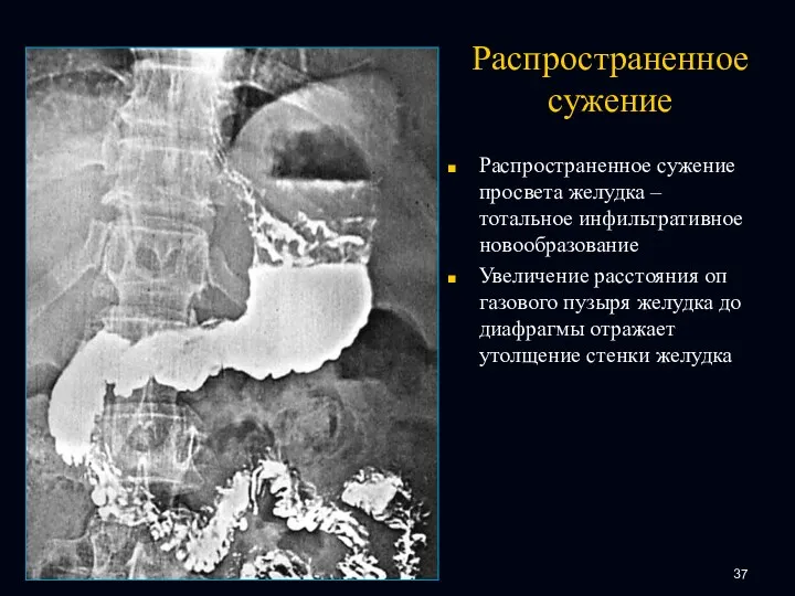 Распространенное сужение Распространенное сужение просвета желудка – тотальное инфильтративное новообразование Увеличение расстояния оп