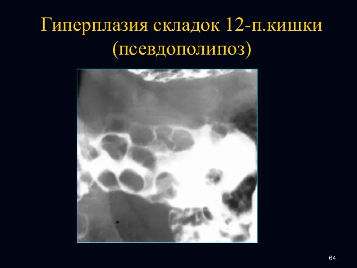 Гиперплазия складок 12-п.кишки (псевдополипоз)