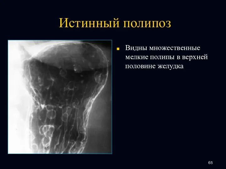 Истинный полипоз Видны множественные мелкие полипы в верхней половине желудка