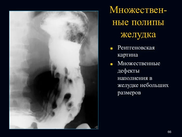 Множествен-ные полипы желудка Рентгеновская картина Множественные дефекты наполнения в желудке небольших размеров