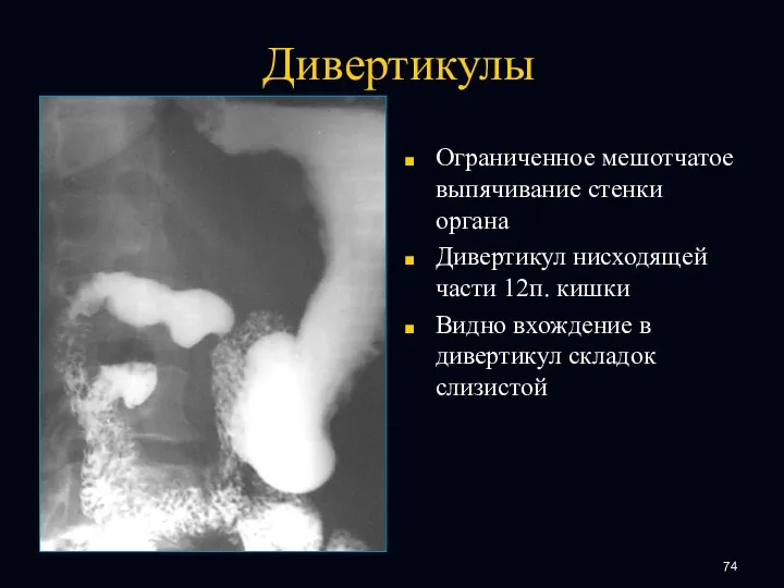 Дивертикулы Ограниченное мешотчатое выпячивание стенки органа Дивертикул нисходящей части 12п. кишки Видно вхождение