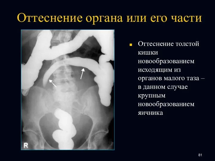 Оттеснение органа или его части Оттеснение толстой кишки новообразованием исходящим из органов малого