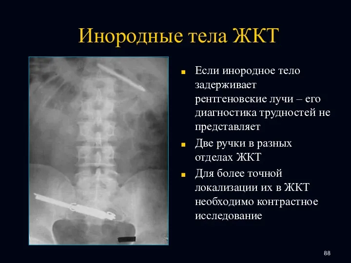 Инородные тела ЖКТ Если инородное тело задерживает рентгеновские лучи – его диагностика трудностей