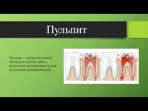 Пульпит Пульпит - воспалительный процесс в пульпе зуба в результате воздействия на нее различных раздражителей.