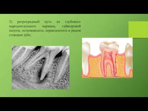 2) ретроградный путь из глубокого пародонтального кармана, гайморовой пазухи, остеомиелите, периодонтите в рядом стоящем зубе;