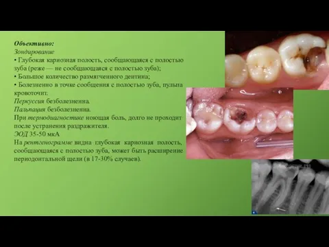 Объективно: Зондирование • Глубокая кариозная полость, сообщающаяся с полостью зуба