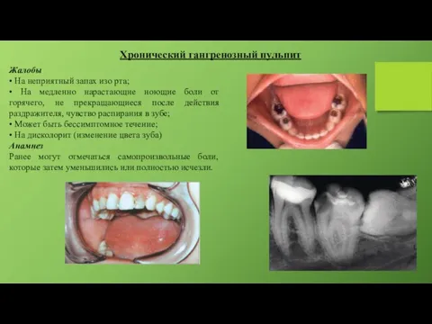Хронический гангренозный пульпит Жалобы • На неприятный запах изо рта;