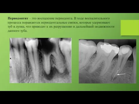 Периодонтит – это воспаление периодонта. В ходе воспалительного процесса поражаются